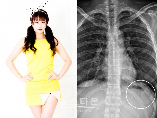 가수 춘향이 무대서 늑골골절 부상 입어, 사진제공=오케이컴퍼니그룹