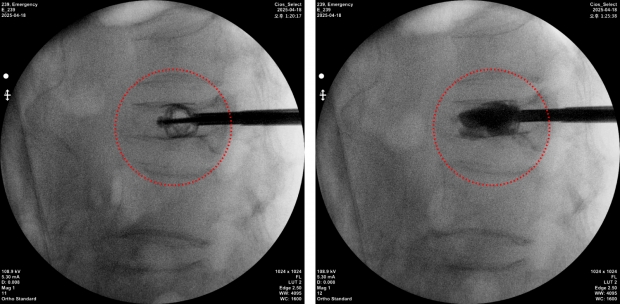 스파인잭 티타늄 임플란트를 삽입해 척추압박골절 환자의 척추체를 정상에 복원한 모습, (국제바로병원제공)